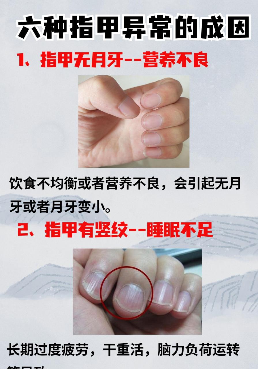 通过指甲反映身体情况:指甲没有月牙—营养不良,指甲有竖纹—睡眠不足
