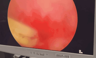 46岁男子膀胱取出5厘米长的蒜苔!