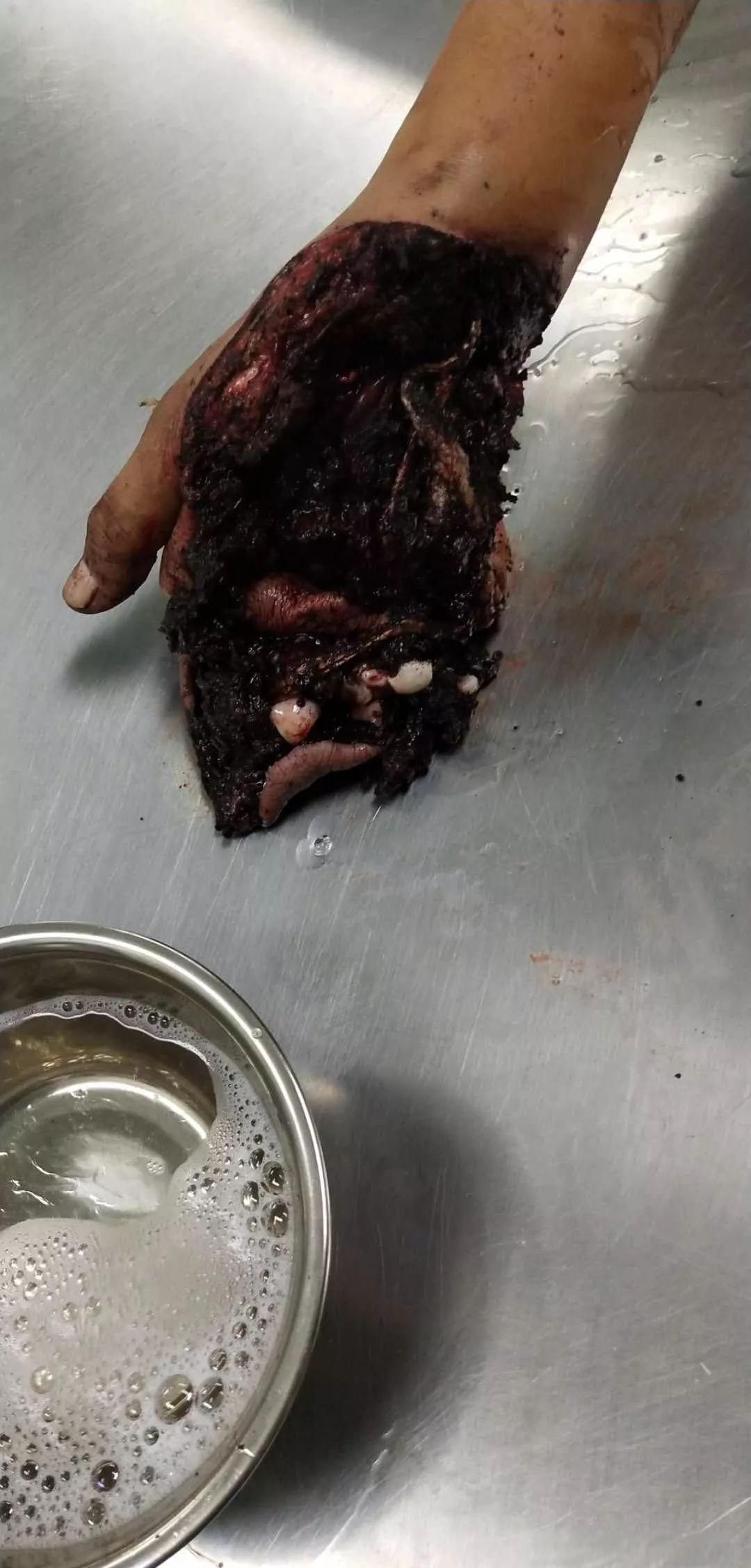 严重手外伤的救治案例