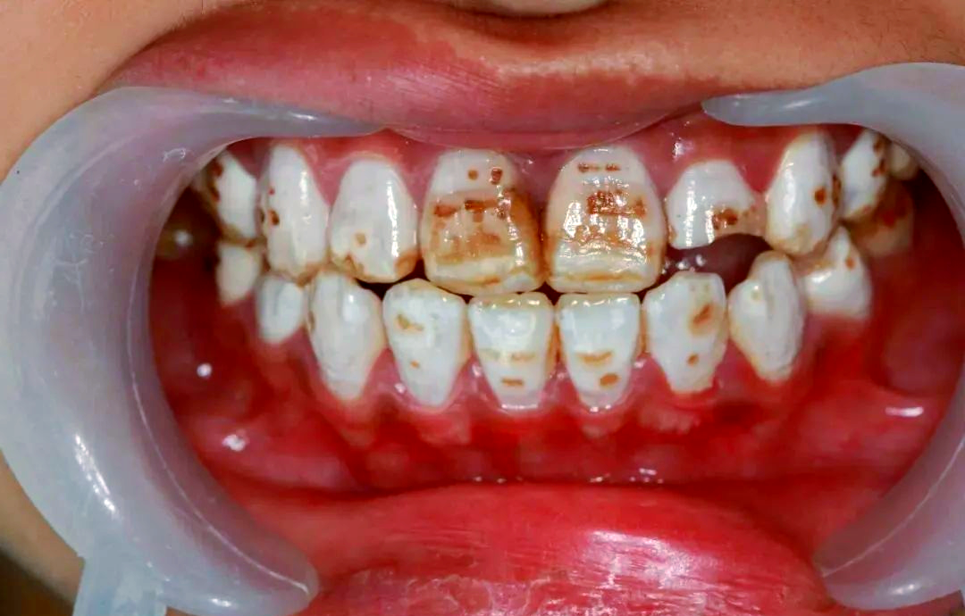 牙齿变黄原因大盘点,找到你的专属答案