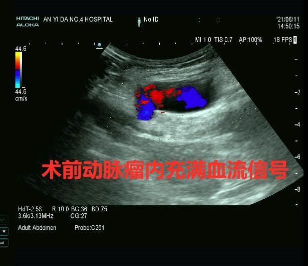 超声引导穿刺 15分钟治疗巨大假性动脉瘤