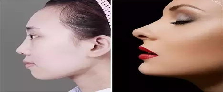 挺鼻子和塌鼻子对比照