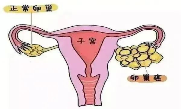 多数卵巢癌患者在疾病早期往往没有特别的不适感,即使少数人有症状,也