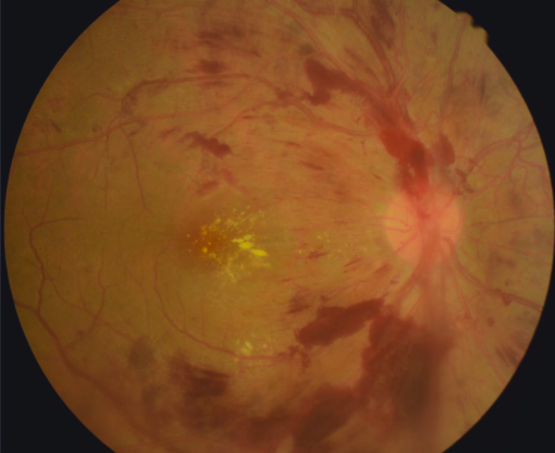 当心"糖网病"偷走了你的视力?