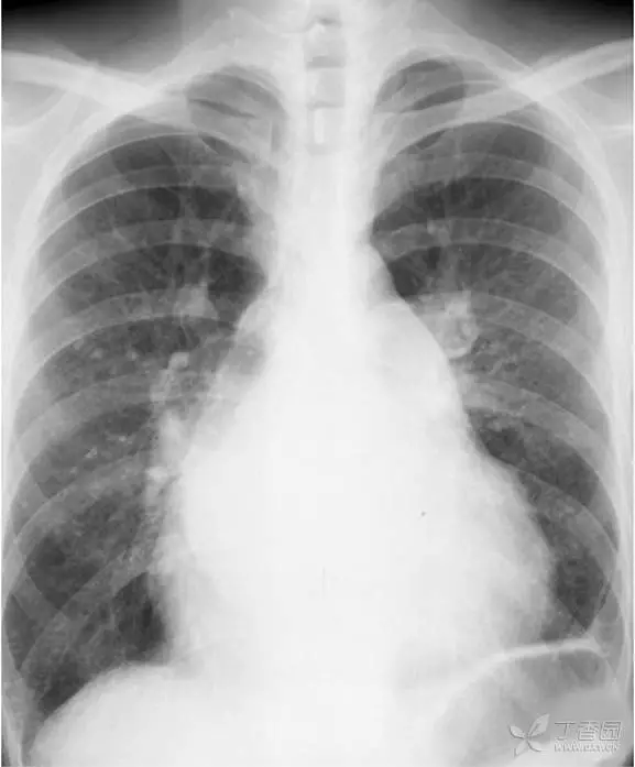 肺门残根征的图图片