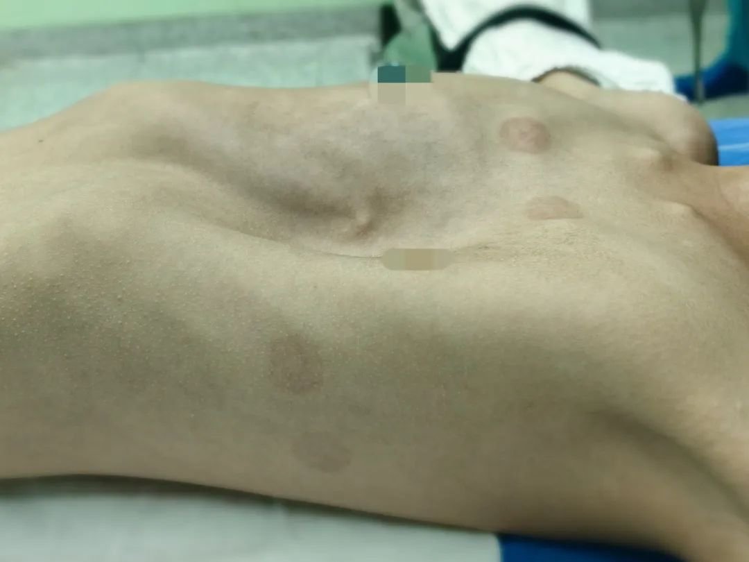 漏斗胸少女的心脏被"挤"到胸腔右侧,广州医生手术施救