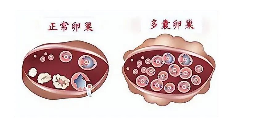 多囊卵巢真实图片图片