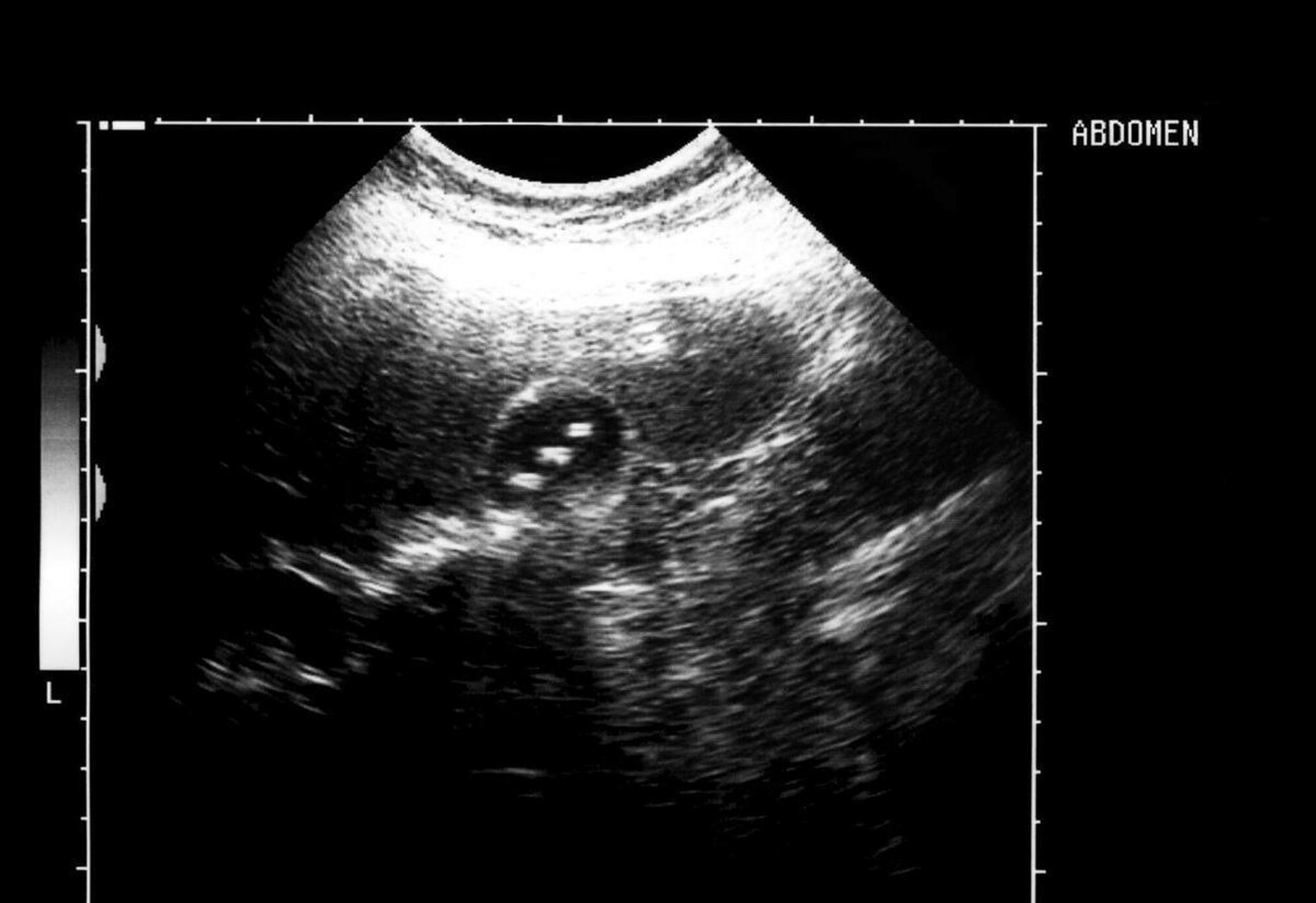 彩超发现胆囊结石 在我问到手术史的时候,吴先生淡定的跟我说他20年