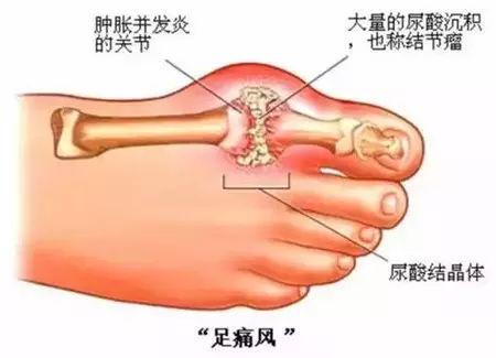痛风疼痛红肿怎么办?下面五种方法教你快速止痛消肿!