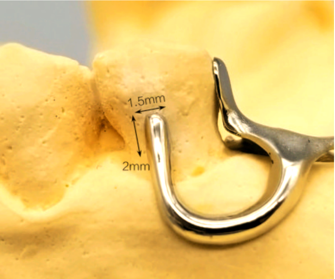 这种卡环的优点在于其美观性,金属部分外露较少,同