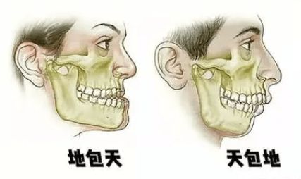 這幾種畸形狀況矯正後可改變臉型