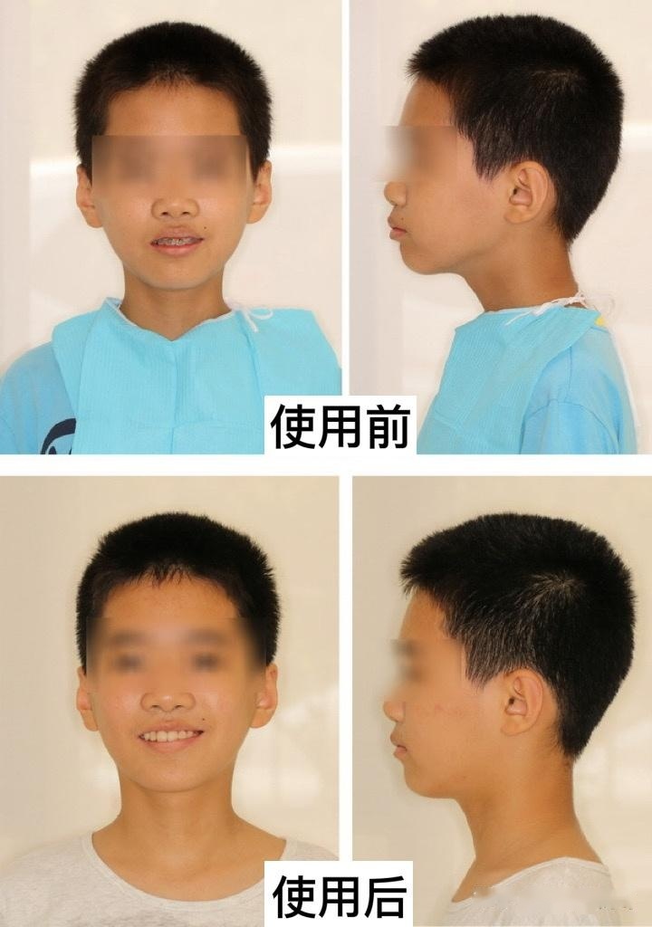 孩子使用唇肌训练器三个月以后得效果