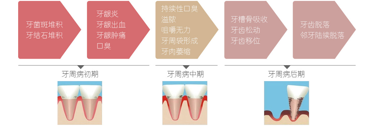 牙周病怎麼治療最有效?健康師深度總結預防和治療方法