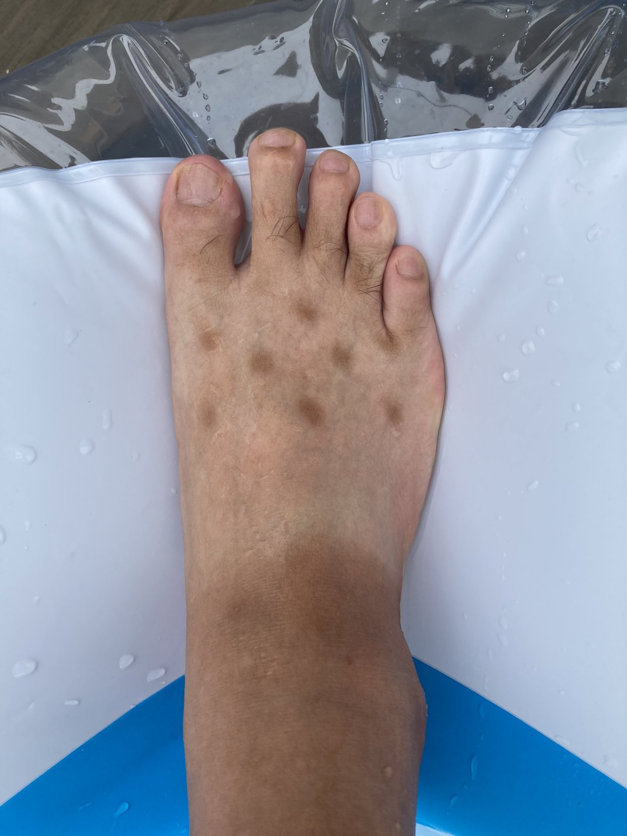 日男脚背上冒出褐色斑点以为得怪病,"同症状"网友哭喊:没救了