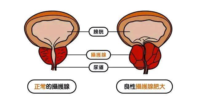 尿频尿急,尿失禁,夜尿多,前列腺肥大怎么办?如何