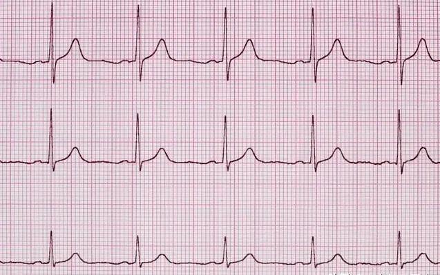 心律不齐的心电图波形图片
