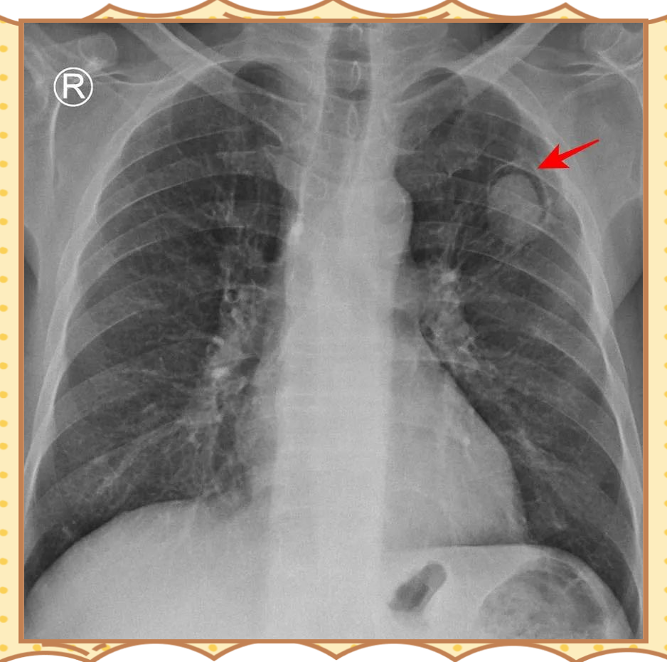 x线胸片常见影像学征象及意义汇总