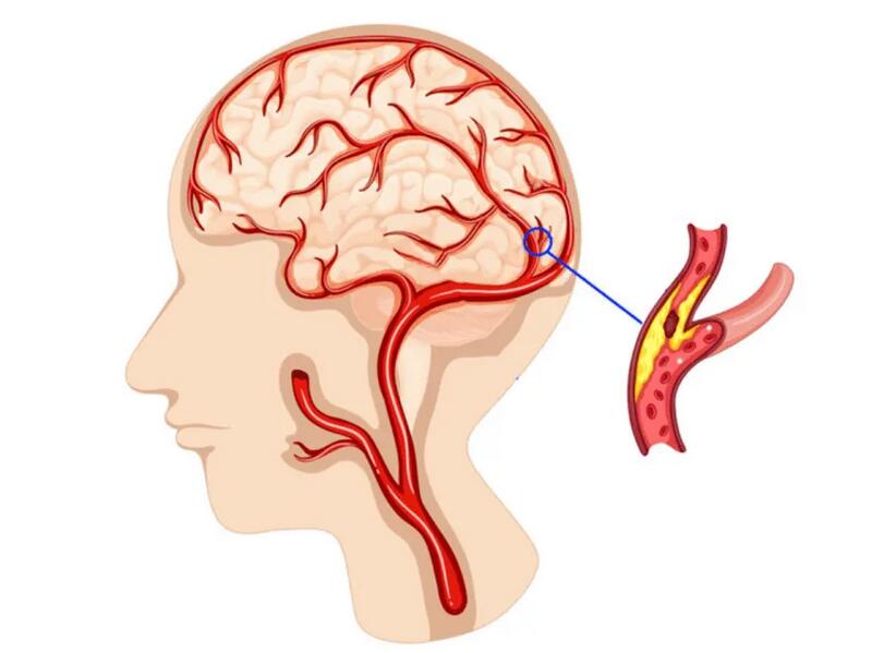 脑梗动画图片