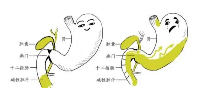 胆汁反流,抓住三伏天,3味药煮水喝,反酸,打嗝赶走
