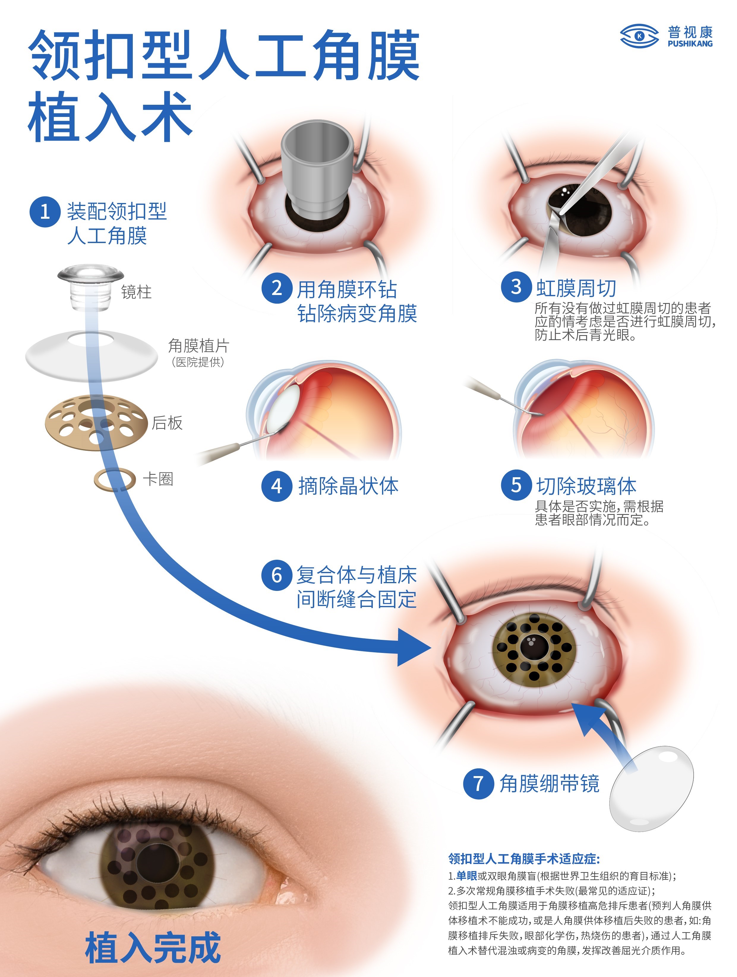 单眼角膜盲患者通过领扣型人工角膜移植成功复明