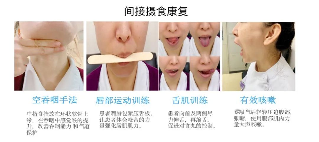 吞咽训练包括 间接摄食康复和 直接摄食康复两种.