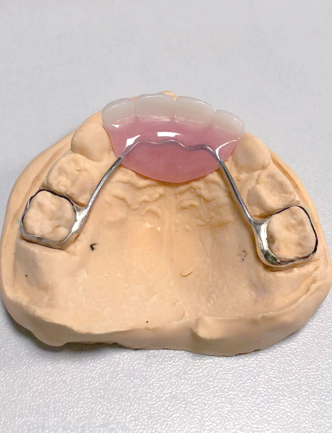 儿童间隙保持器科普:种类与使用