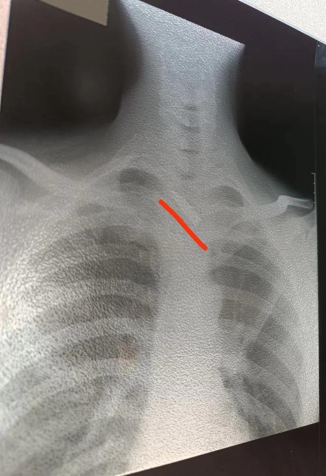 厄特男子颈部中弹10余年,河南省肿瘤医院邢宏彬冒险取出