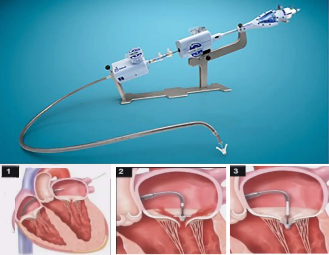 山东首例!超声引导下经导管二尖瓣夹合手术取得成功