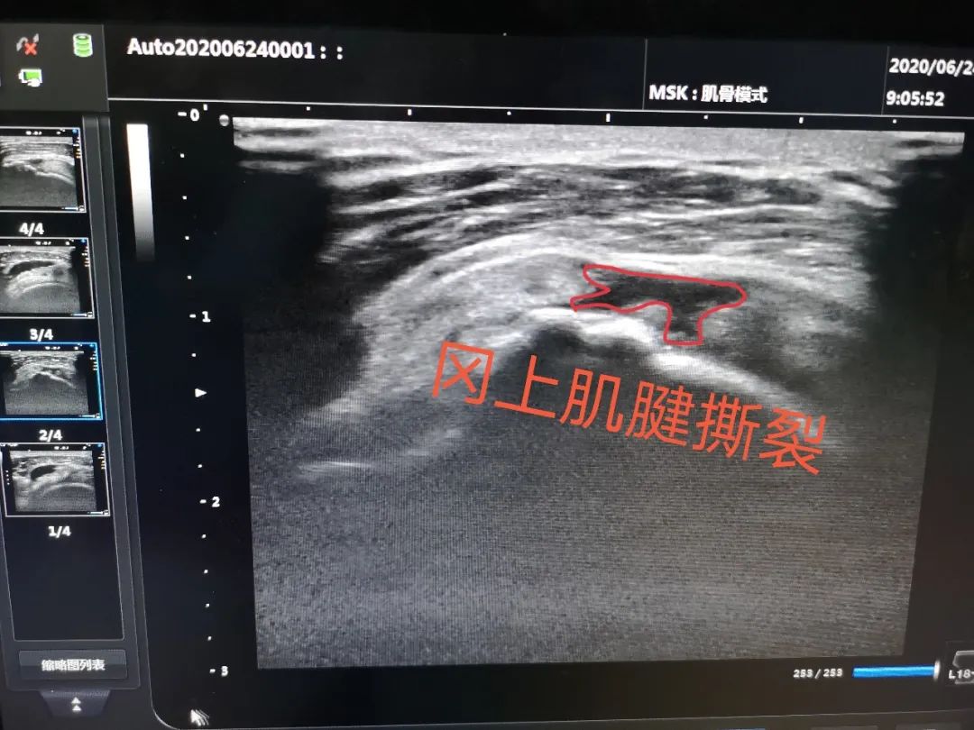 肩膀疼痛别轻视 可能是冈上肌撕裂