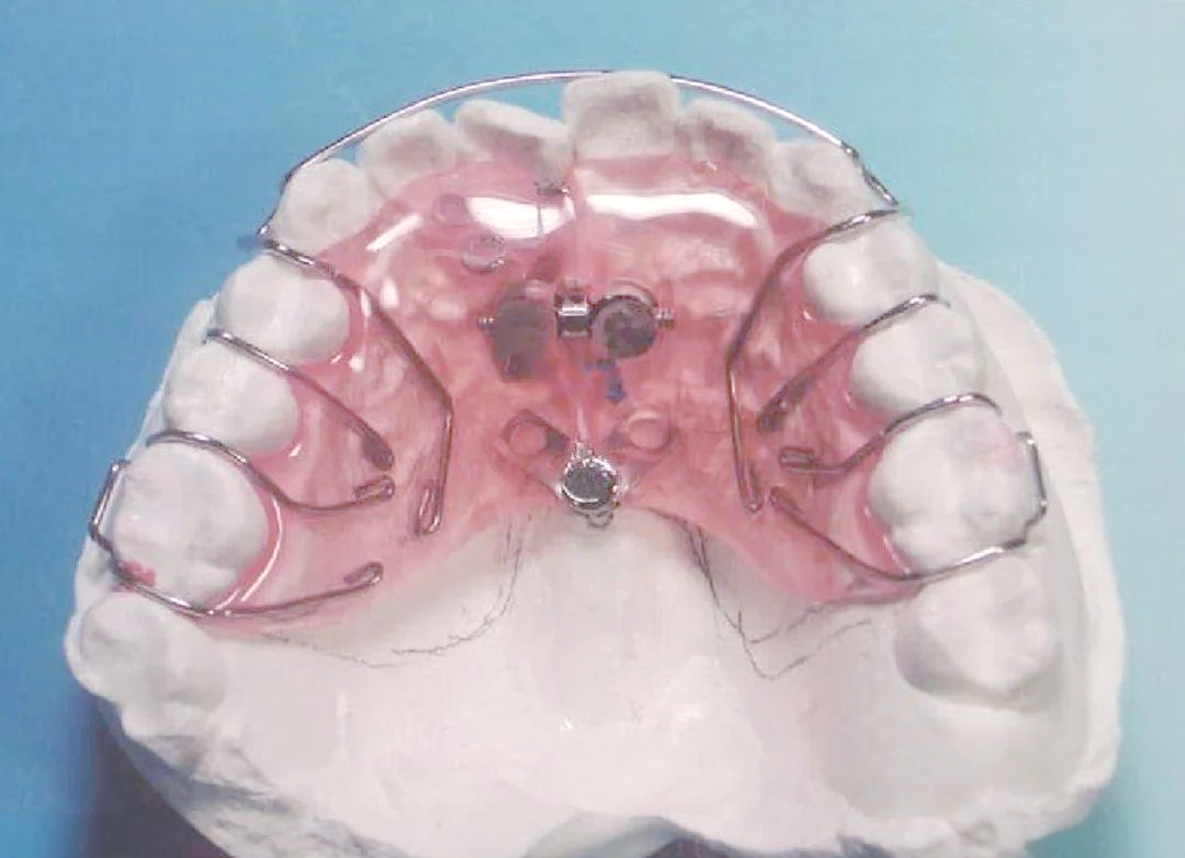 正畸活动矫治器相关的多种图谱与信息