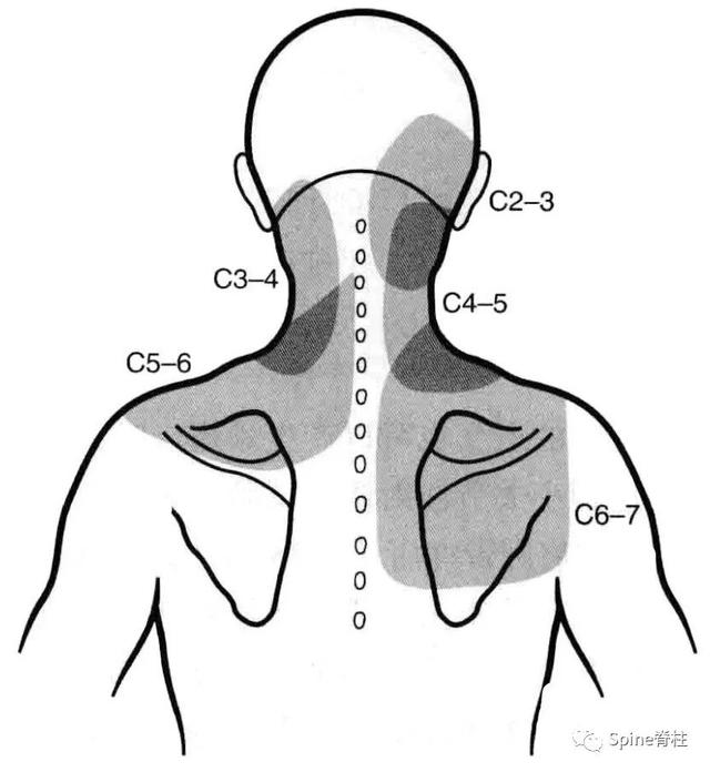 回顾:颈椎病 cervical spondylosis