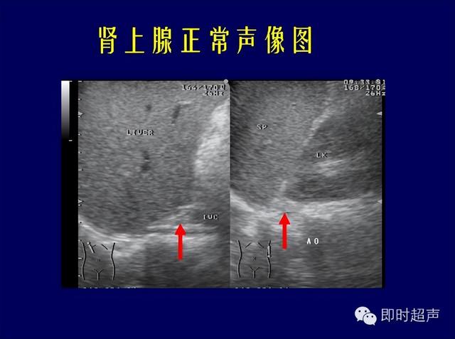 肾上腺解剖及超声病例解析