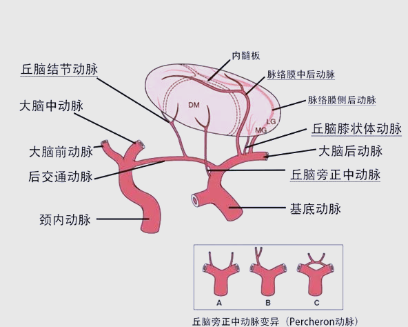 揭秘穿支动脉梗死和腔隙性梗死的不同与治疗策略