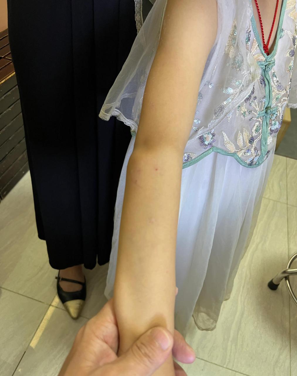 这个4岁女孩,家长发现小孩的肘部后面鼓起了个"包",问她疼不疼,她说没