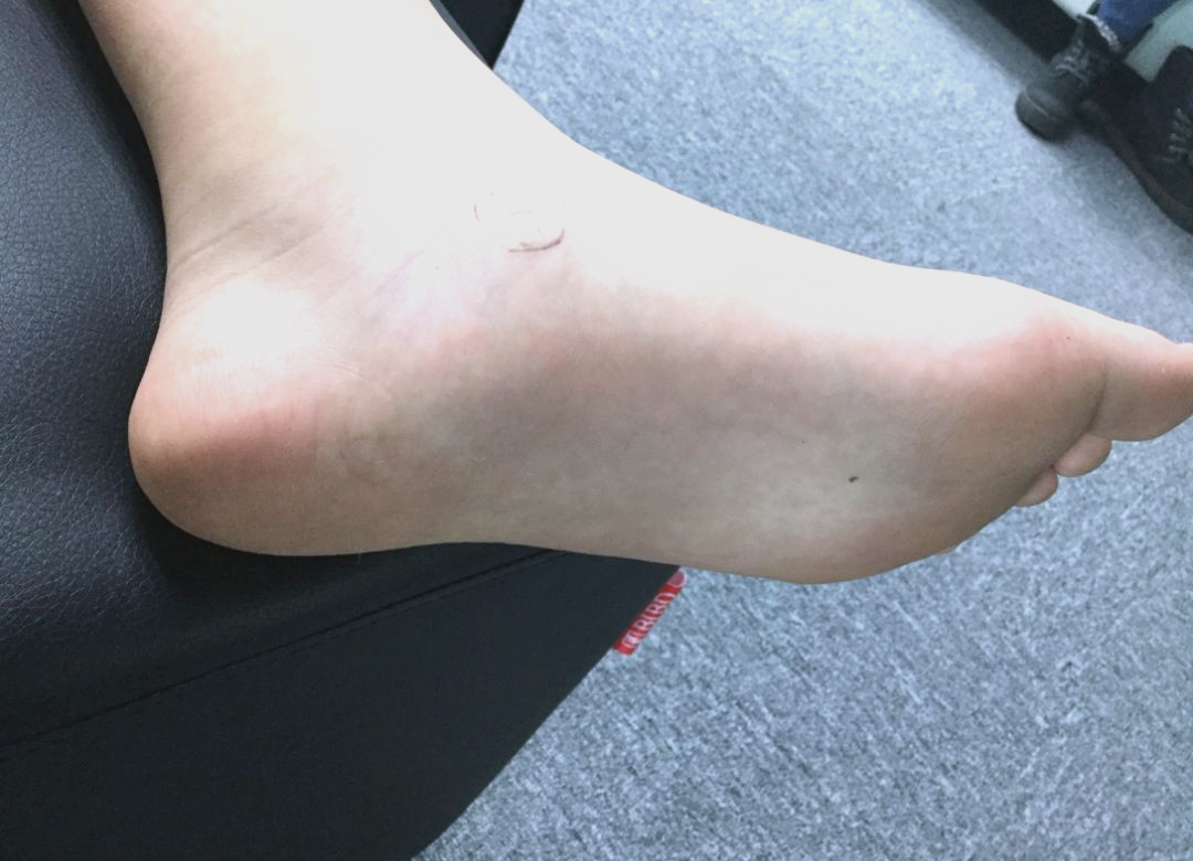 12岁男孩的扁平足问题如何缓解运动疼痛