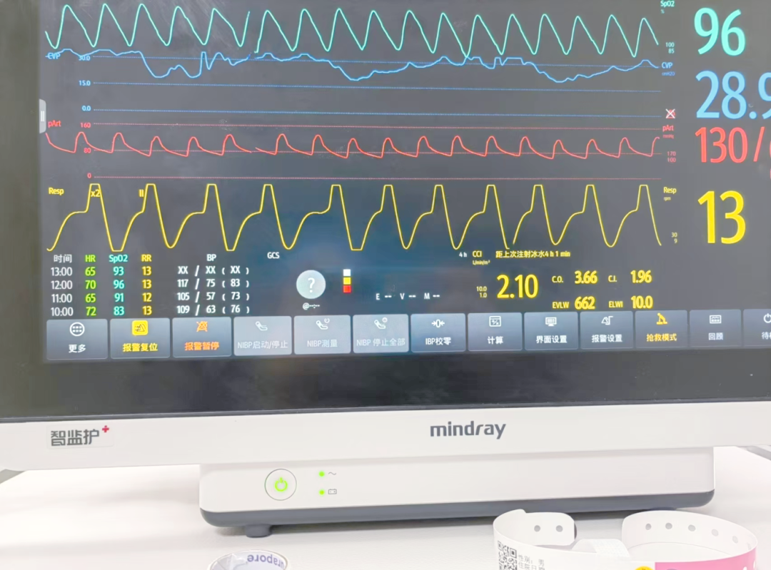 —重症患者血流动力学监测的得力助手