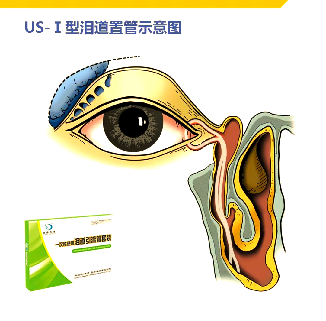 us-i型泪道引流管:革新性手术工具的秘密
