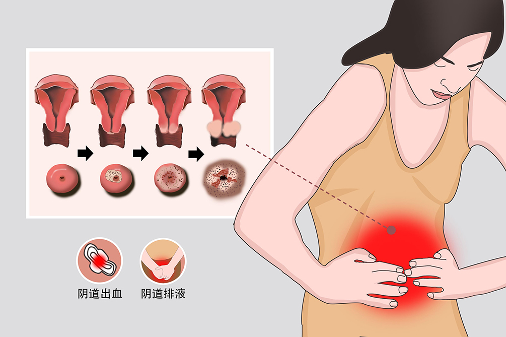宫颈上皮内瘤样病变(cin)就是宫颈癌吗?