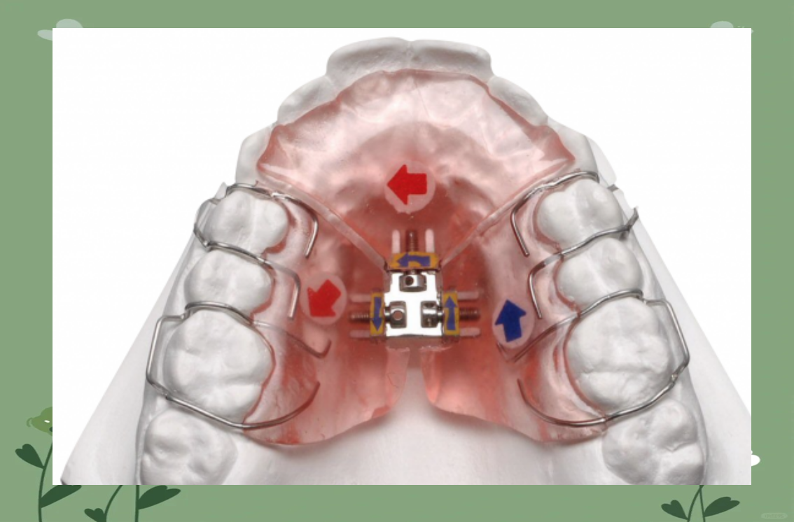 活动矫治器:结构,优缺点及临床应用综述