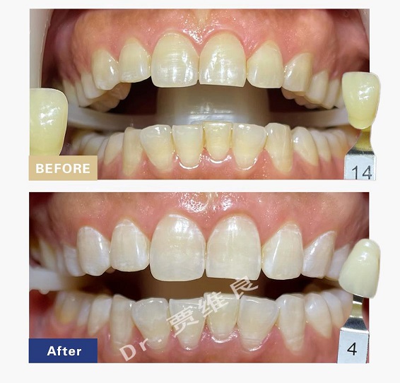 hiteeth皓得适牙齿美白效果好不好?