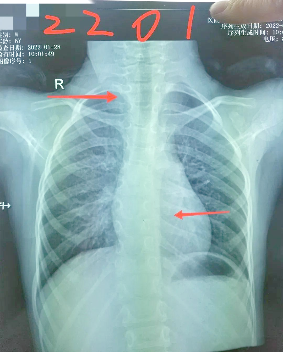 胸片能揭示的脊柱健康信息,医生与家长必看
