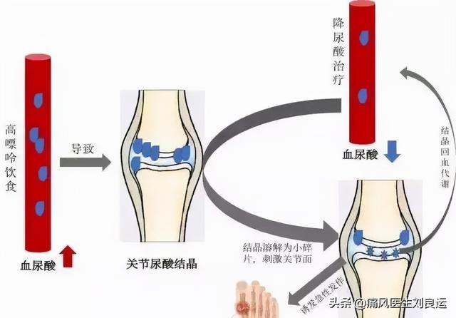 降尿酸过程中痛风发作,是痛风治疗无效吗?医生告诉您怎么办