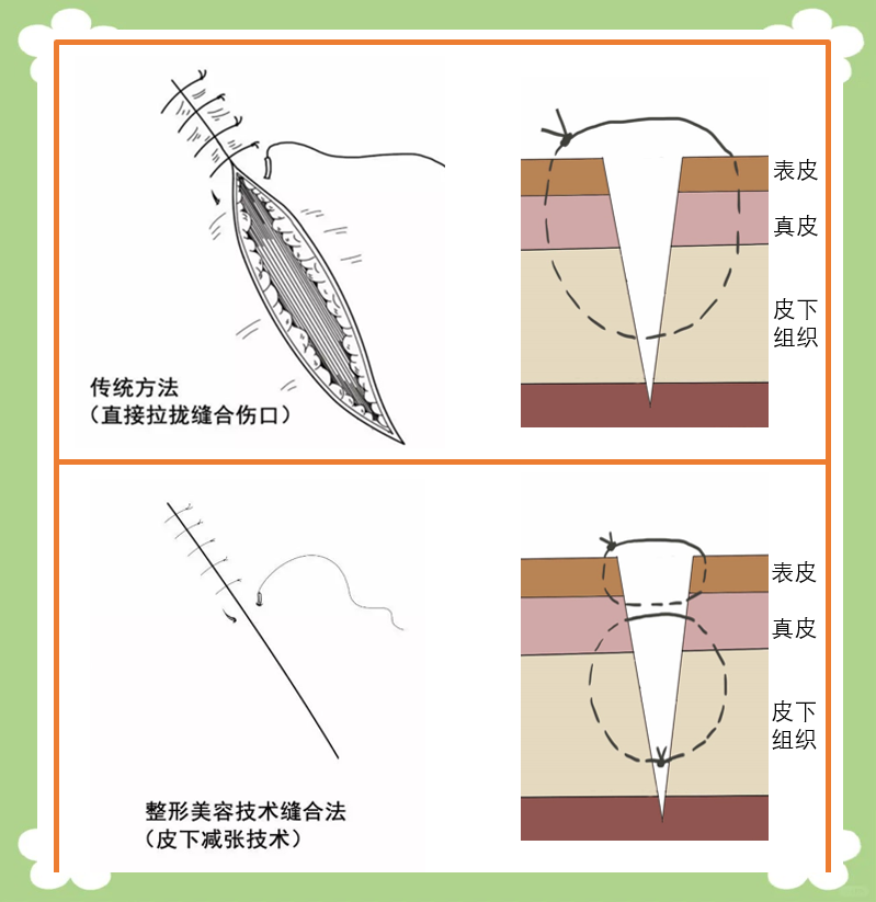 美容缝合技术:让伤口愈合更美观