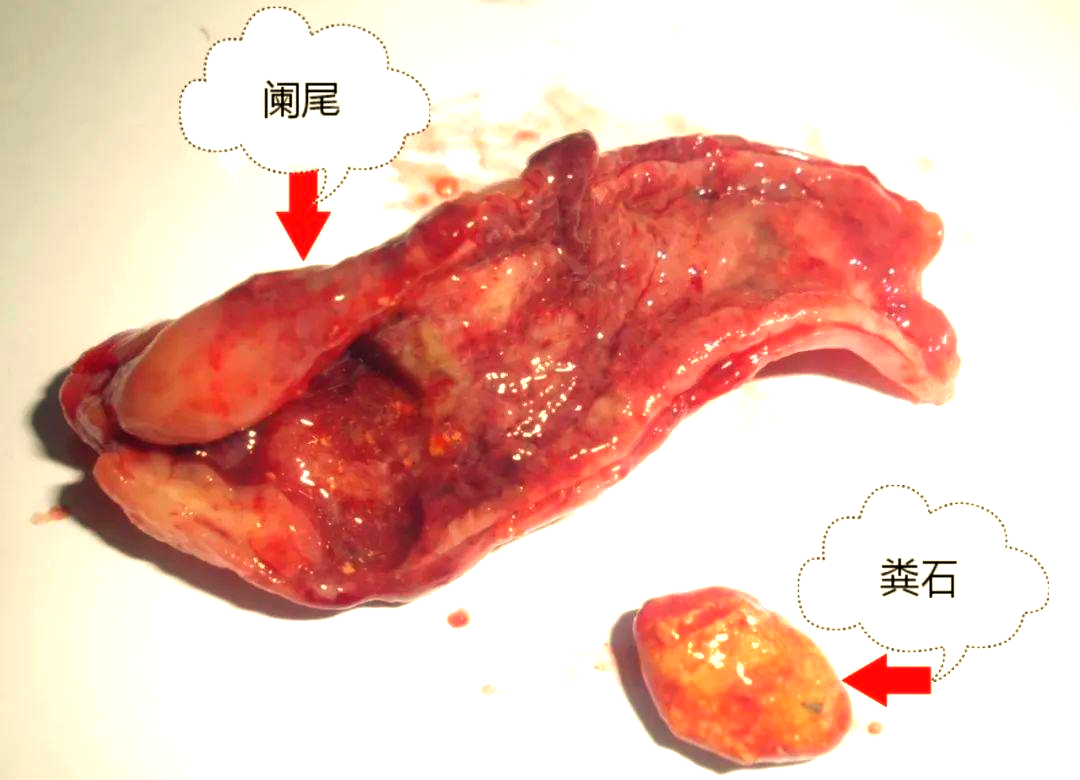 医学科普:全面了解阑尾炎