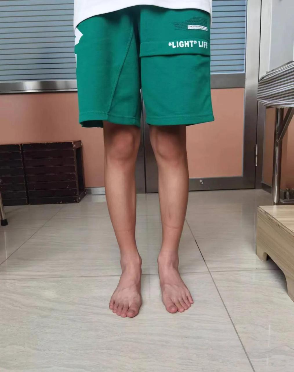 大多时候,o型腿和足外翻是有关系的,当足外翻改善了,足弓形成了,足跟