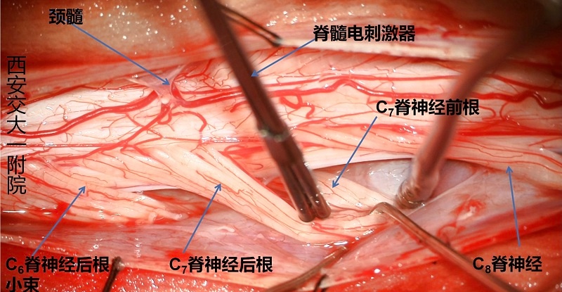 医生施西部首例颈段选择性脊神经后根部分切断术获成功