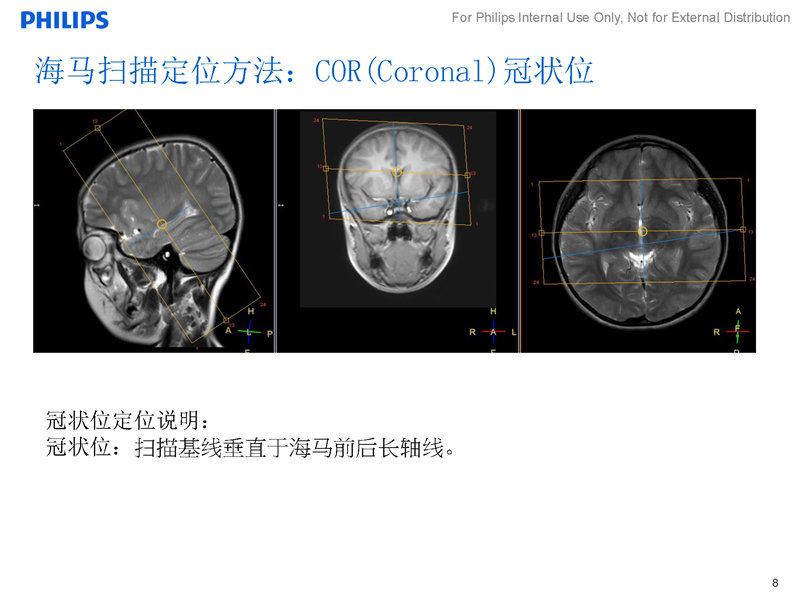 海馬平掃掃描方案|磁共振規範化掃描方案|飛利浦