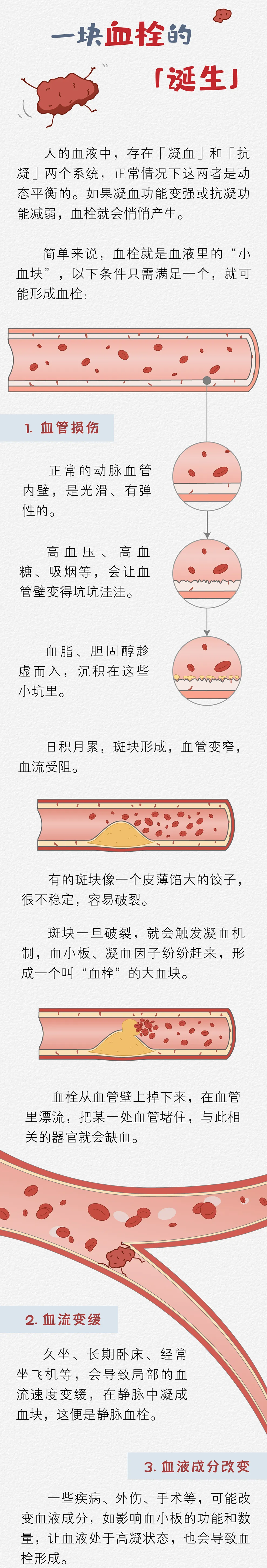 血栓科普:"三个条件"形成血栓,"血栓"高发的"7个人群"
