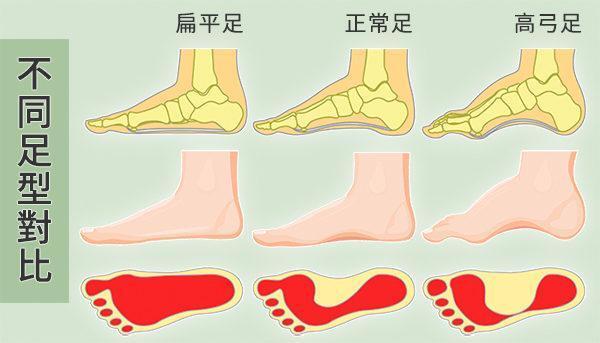 扁平足傷踝傷膝,但足弓越高就越穩嗎?