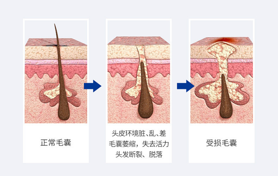 毛囊堵塞怎么疏通图片